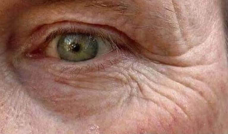 como renovar la piel y reducir las arrugas profundas