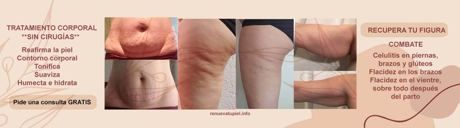 Recuparar la figura después del parto, quitar celulitis y flacidez