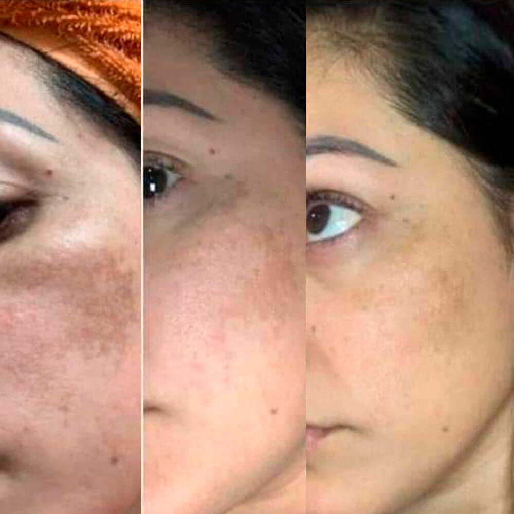 como quitar las manchas hormonales de la piel