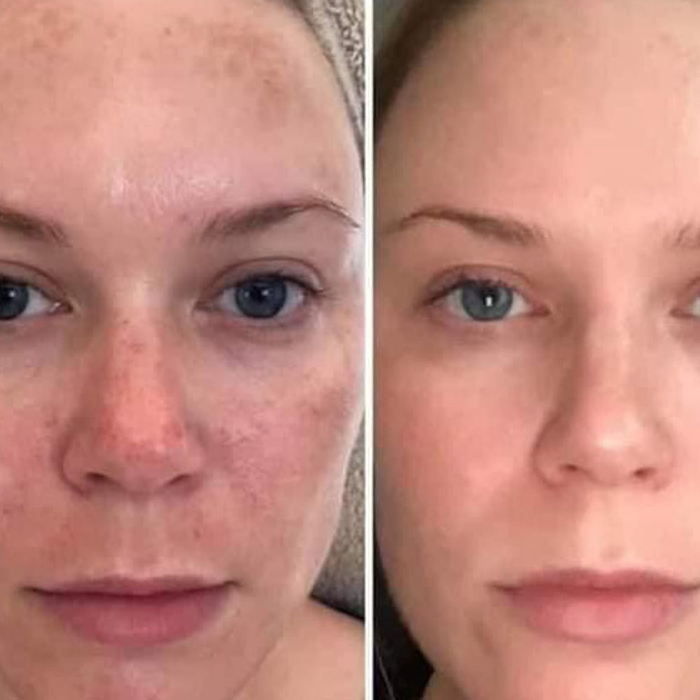 skincare piel sensible rojez y manchas